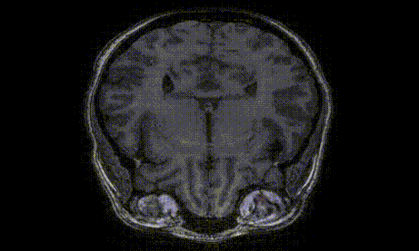 Coronale MRI-scan van de oogkas waarop het segmentatiemodel vet- en spierweefsel rond de ogen heeft gemarkeerd
